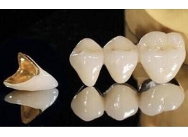 美莱口腔医生：如何降低烤瓷牙副作用风险