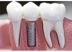 上海牙齿治疗的寿命有多长