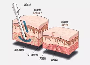 吸脂手术六大问