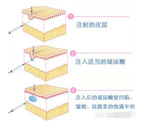 玻尿酸VS进口注射瘦脸 除皱哪个更强？