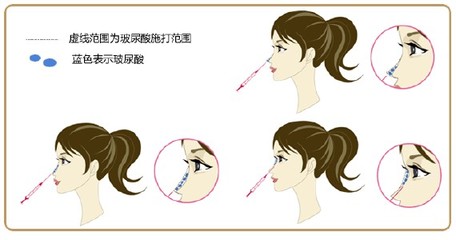 上海注射隆鼻是有效的吗