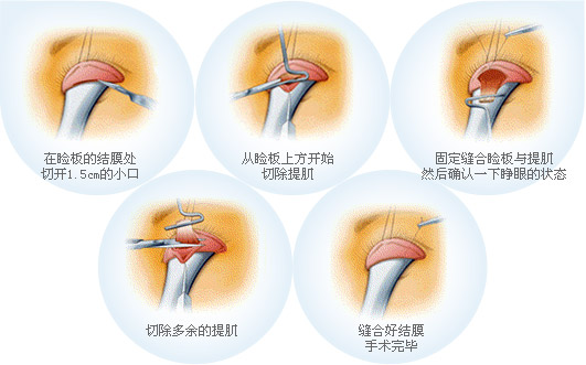 先天性上睑下垂怎么矫正