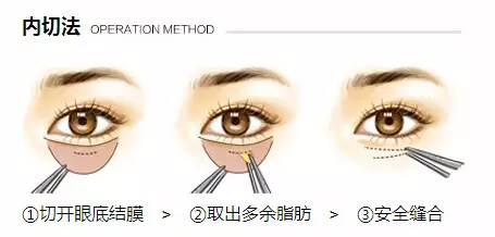 有眼袋老10岁 如何快速祛眼袋