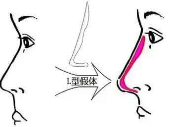 隆鼻方式那么多，哪个适合你？