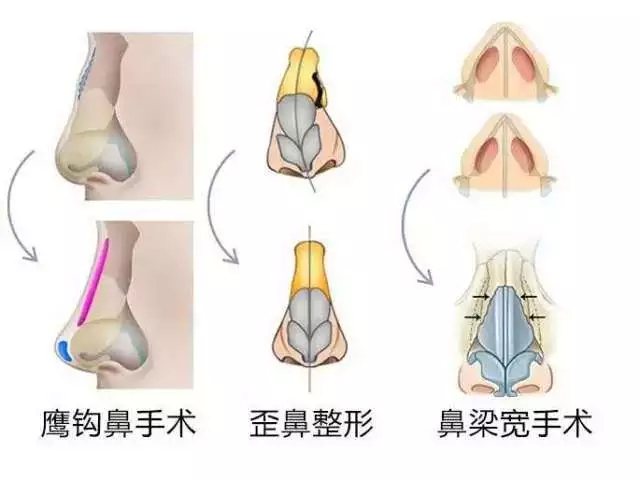 美鼻先要知道“海鸥线”