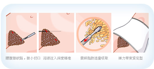 上海腰腹部抽脂减肥多少钱