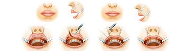唇部整形的手术方法有哪些
