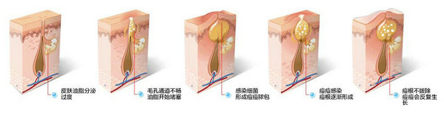 上海美莱激光祛痘的特点有哪些