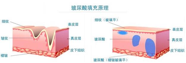 上海玻尿酸祛鱼尾纹要多少钱