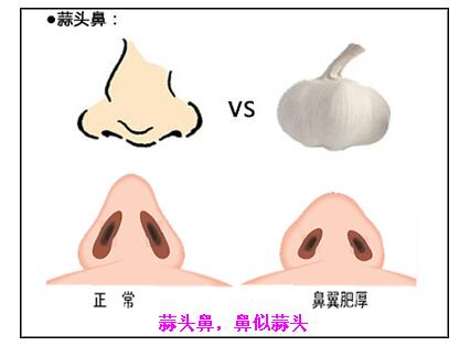 上海蒜头鼻鼻型矫正要多少钱