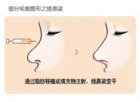韩式假体隆鼻能让鼻子更挺