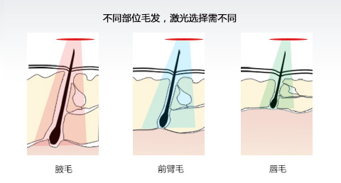 上海激光全身脱毛疼吗