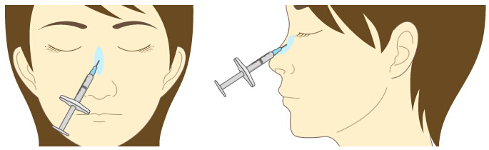 玻尿酸隆鼻能维持多久