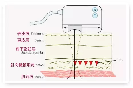 上海美莱微整形——快速提拉瞬间年轻焕颜