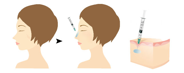 玻尿酸注射隆鼻失败怎么办