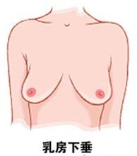 上海哪里做乳房下垂矫正好