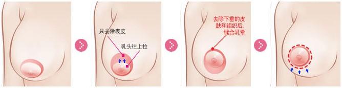 乳房下垂有哪些危害