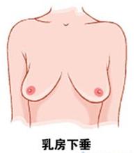 乳房下垂有危害，要及时矫正