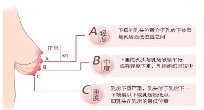 乳房下垂怎样丰胸