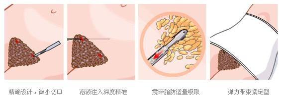 上海腰腹部吸脂多少钱