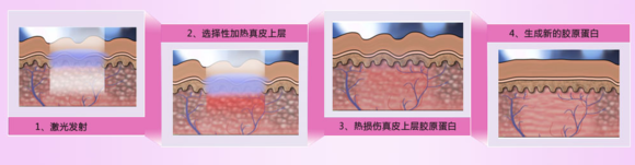 激光美白要多长时间恢复