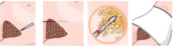 腰腹部吸脂术效果如何