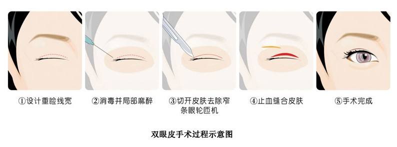 上海双眼皮手术的效果如何