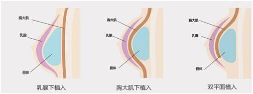 上海假体隆胸植入位置