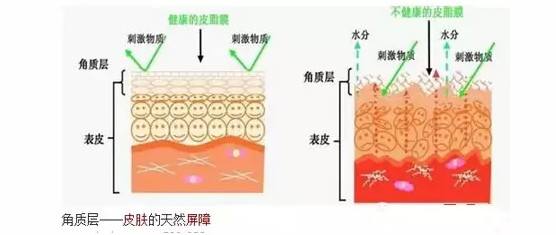 激光去红血丝有用吗