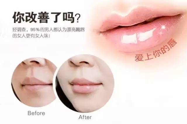 上海美莱玻尿酸丰唇打造属于你的嘟嘟唇