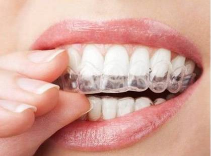上海牙齿矫正一般需要多少钱