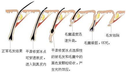 激光脱毛