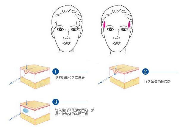 太阳穴凹陷改善