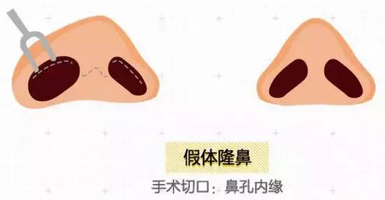 上海美莱隆鼻整形手术
