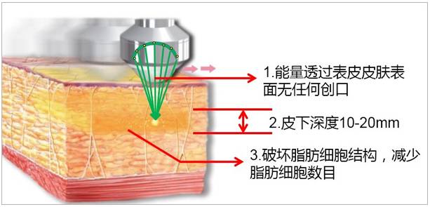 上海美莱聚焦超声吸脂原理