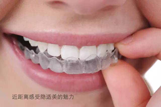上海美莱隐形牙齿矫正