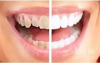 牙齿美白较好的方法