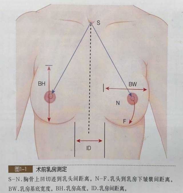 假体隆胸术前测量