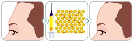 玻尿酸丰额头的注意事项有哪些
