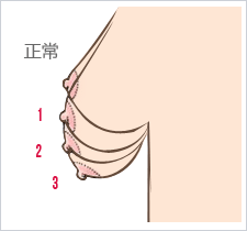 乳房下垂程度