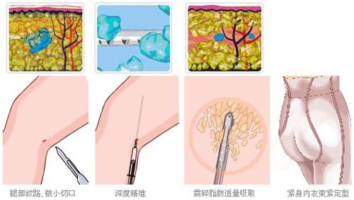 上海吸脂瘦腿多少钱