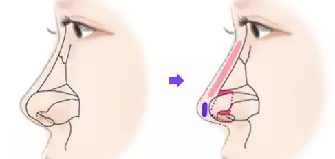 假体隆鼻后注意事项是什么