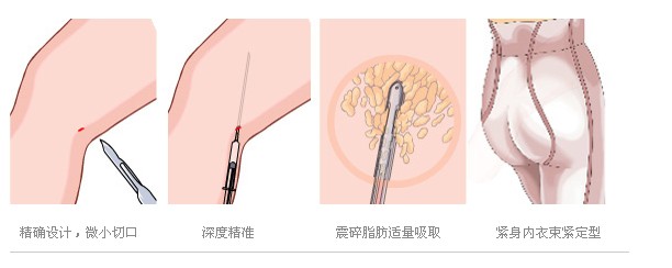 上海腿部吸脂手术多少钱