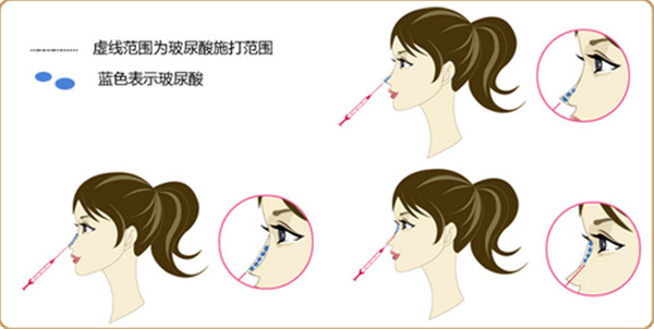 玻尿酸注射隆鼻