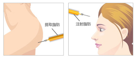 美莱自体脂肪丰额头效果