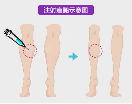 瘦腿神器——瘦腿
