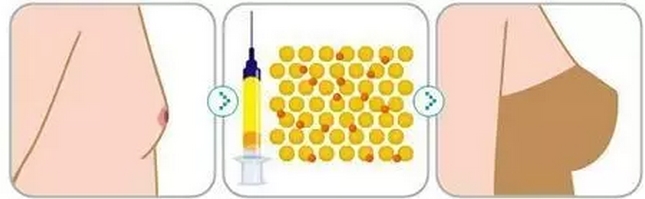自体脂肪丰胸价格是多少