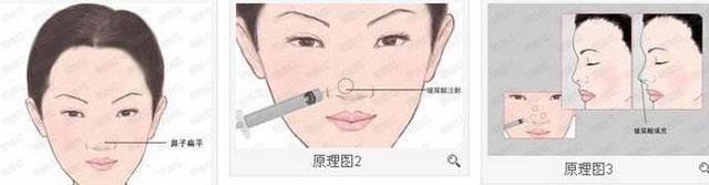 上海玻尿酸注射隆鼻