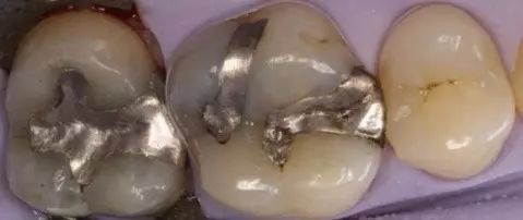 银汞合金修复牙齿