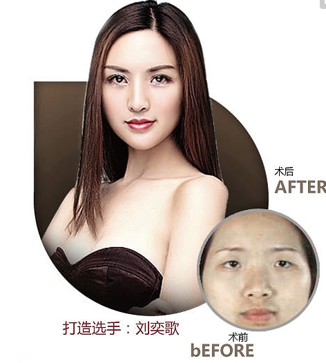 上海美莱割双眼皮一般多少钱
